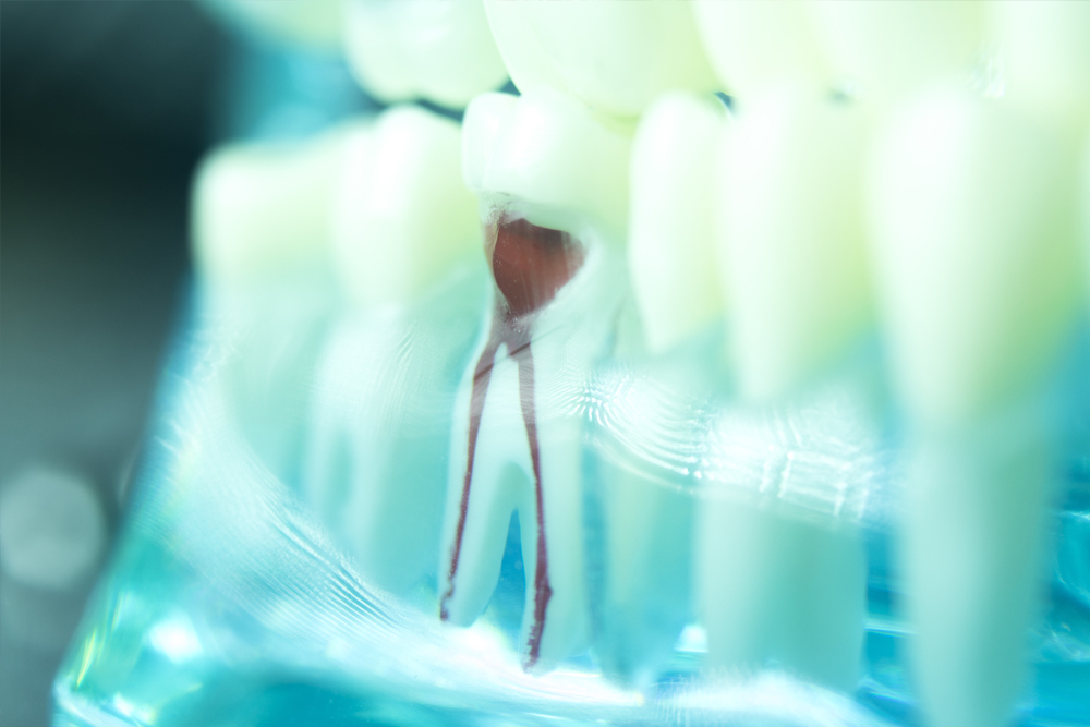Root canal surgery